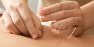 BodyKore Monaghan - Acupuncture