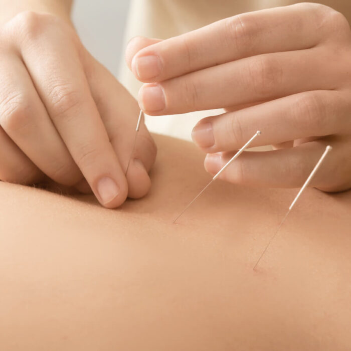 Buy Acupuncture Treatment Online from BodyKore Monaghan